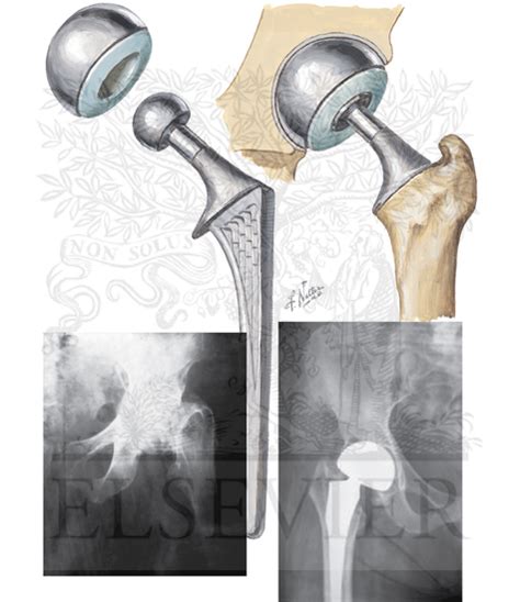 hip hemiarthroplasty orthobullets|Prophylactic Bipolar Hemiarthroplasty of the Hip .